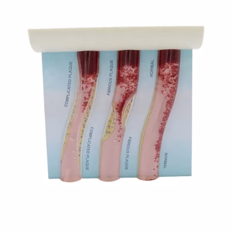 Hyperlipaemia Model Human Blood Vessel Anatomical Model Medical Science